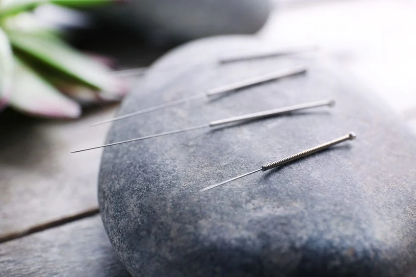 Acupuncture needles being placed during a treatment for chronic pain