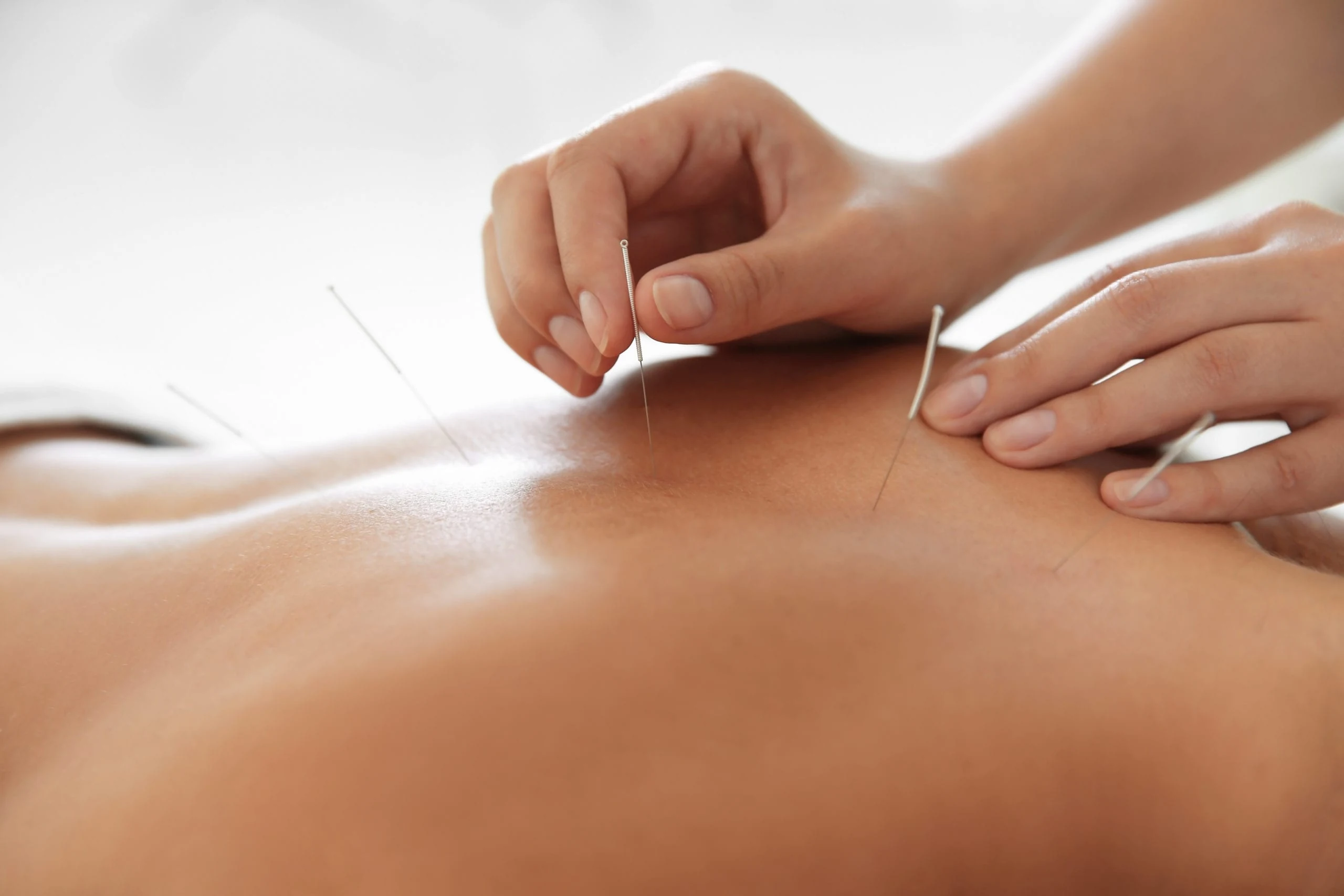 Secret Garden Holistic Therapies Acupuncture Treatment